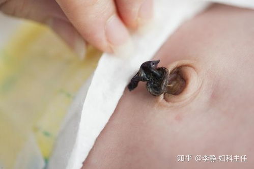 肚脐眼里黑色的脏东西能抠吗 它们到底是什么